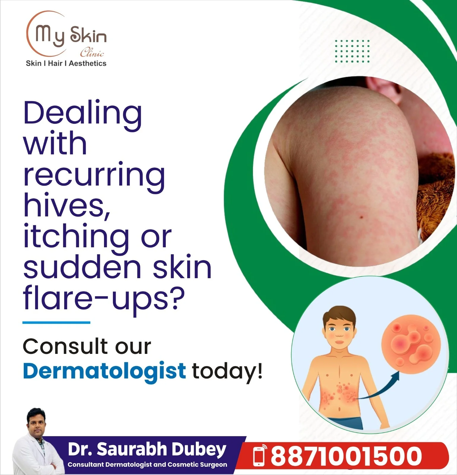 Hives Treatment in Indore